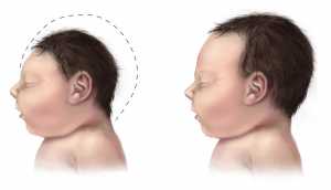 Image of a baby with microcephaly (left) compared to a normal baby (right). This is one of the potential effects of Zika virus. Signs of microcephaly may develop a few months after birth. Wikipedia image