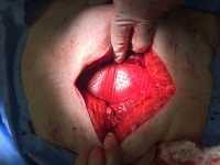 OviTex Reinforced BioScaffolds for Abdominal Wall Reconstruction