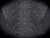 Probe being applied to nerve root. Credit: Radiological Society of North America