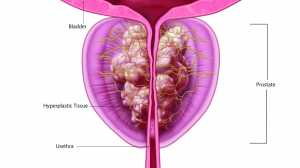 Pre Treatment.jpg: Benign prostatic hyperplasia (BPH) is an enlargement of the prostate gland, affecting 12 million men in the U.S., with nearly 800,000 newly diagnosed each year. An enlarged prostate squeezes down on the urethra causing lower urinary tract symptoms.