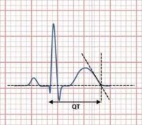 Electrocardiogram showing QT interval calculated by tangent method Wikipedia image