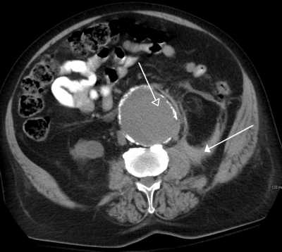 ruptured Abdominal Aortic Aneurysm as seen on CT- Wikipedia James Heilman, MD