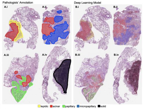 Visualization on sample whole-slide images of the lung cancer histologic patterns identified by pathologists compared to those detected by a new machine learning model developed by researchers at Dartmouth's Norris Cotton Cancer Center. The team rendered the image by overlaying color-coded dots on patches based on decisions generated by their computer model. A subjective qualitative assessment by pathologist annotators confirmed that the patterns detected on each slide are on target. CREDIT Hassanpour Lab, Dartmouth's Norris Cotton Cancer Center