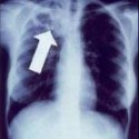 Tuberculosis creates cavities visible in x-rays like this one in the patient's right upper lobe. Wikipedia