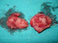 A pair of tonsils after surgical removal Wikipedia image