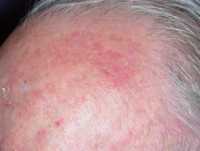 One example of actinic keratoses on scalp DermNZ