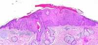 “Actinic Keratosis” by Ed Uthman is licensed under CC BY 2.0