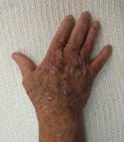 Actinic Keratosis Wikipedia image