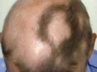 alopecia-areata-dermnet-nz