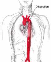 Dissection of the descending part of the aorta (3), which starts from the left subclavian artery and extends to the abdominal aorta (4). The ascending aorta (1) and aortic arch (2) are not involved in this image Wikipedia image
