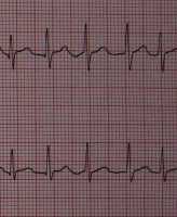 atrial-fibrillation-wikipedia-image
