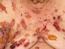 Example of Bullous Pemphigoid Derm NZ image