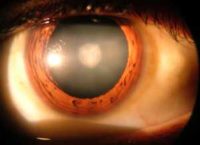 cataract-eye-wikipedia Cataract in Human Eye author Rakesh Ahuja, MD