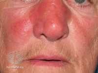 Example of cellulitis erysipelas from DermnetNZ.org