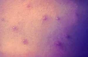 Depicted here, is a close-up of a maculopapular rash that was diagnosed as a crop of chickenpox lesions.