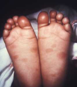 This image depicts a plantar view of an infant’s feet, revealing the presence of syphilitic lesions, which resulted from a case of congenital syphilis. If not immediately treated, babies may become developmentally delayed, have seizures, or die. Symptoms may not become initially apparent, but can develop within a few weeks. These signs and symptoms can be very serious.