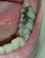 "Teeth in disarray" by Teresa Trimm is licensed under CC BY-SA 2.0. To view a copy of this license, visit: https://creativecommons.org/licenses/by-sa/2.0