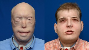 Patrick Hardison before surgery (left) and in November 2015, nearly three months after the surgery