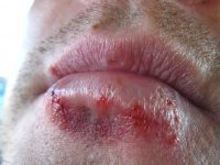 "Herpes" by LEONARDO DASILVA is licensed under CC BY 2.0