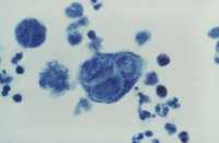herpes-tzanck-hsv CDC image