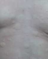 Hives - Wikipedia image James Heilman, MD - Own work