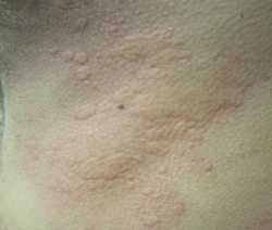 Hives-Urticaria Wikipedia image