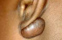 example of keloid