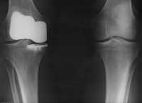 “3 of 3 X-ray Journey Deuce knee replacement, Michael L. Baird 29 Dec. 2008” by Mike Baird is licensed under CC BY 2.0