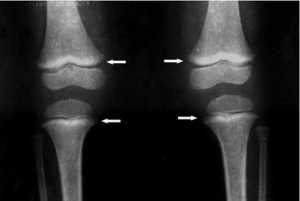 From CDC:Long Bone Radiograph of Knees - "lead lines" in three-year old girl with BLL of 0.6 µg/dL. Notice the increased density on the metaphysis growth plate of the knee, especially in the femur (Photo courtesy of Dr. Celsa López, Clinical Epidemiologic Research Unit, IMSS, Torreón, México).