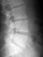 "Lateral View Lumbar Spine X-Ray" by planetc1 is licensed under CC BY-SA 2.0 CC BY-SA 2.0