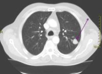 CT scan showing a cancerous tumor in the left lung Wikipedia image