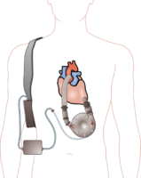 A left ventricular assist device (LVAD) pumping blood from the left ventricle to the aorta, connected to an externally worn control unit and battery pack. Wikipedia image