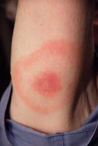 This 2007 photograph depicts the pathognomonic erythematous rash in the pattern of a “bull’s-eye”, which manifested at the site of a tick bite on this Maryland woman’s posterior right upper arm, who’d subsequently contracted Lyme disease. Lyme disease patients who are diagnosed early, and receive proper antibiotic treatment, usually recover rapidly and completely. A key component of early diagnosis is recognition of the characteristic Lyme disease rash called erythema migrans. This rash often manifests itself in a “bull's-eye” appearance, and is observed in about 80% of Lyme disease patients. Lyme disease is caused by the bacterium Borrelia burgdorferi, and is transmitted to humans by the bite of infected blacklegged ticks. Typical symptoms include fever, headache, fatigue, and as illustrated here, the characteristic skin rash called erythema migrans. If left untreated, infection can spread to joints, the heart, and the nervous system. Note that there are a number of PHIL images related to this disease and its vectors.
