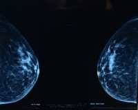 "Mammogram" by slgckgc is licensed under CC BY 2.0