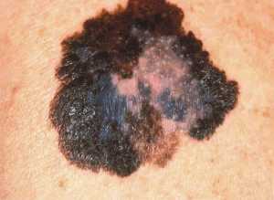 This image depicts the gross appearance of a cutaneous pigmented lesion, which had been diagnosed as superficial spreading malignant melanoma (SSMM). Note the roughened edges of this mole, and its heterogeneous, mottled, multicolored appearance, which are all characteristics that should evoke suspicions about its classification.