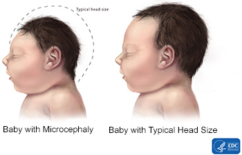 In Brazil an increase in cases of infants born with microcephaly (small head) has been noted coincident with the Zika epidemic, and the virus has been recovered from amniotic fluid and from fetal tissue, suggesting that Zika infection during pregnancy may cause microcephaly in the developing fetus. An increase in cases of Guillain-Barre syndrome has also been observed during this and previous outbreaks. Studies are underway to determine if Zika virus is the cause of microcephaly and Guillain-Barre syndrome.