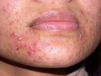 Moderate Acne Derm NZ image