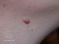 mole-dermal-nevus-dermnetnz