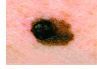One example of malignant melanoma, courtesy of skin cancer foundation