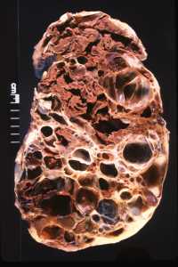 “Adult Polycystic Kidney” by Ed Uthman is licensed under CC BY 2.0