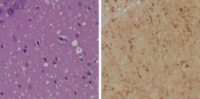 (Left) Staining shows spongiform degeneration. (Right) Staining shows intense misfolded prion protein. Credit: Case Western Reserve University School of Medicine