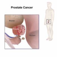 Prostate Cancer - Wikipedia