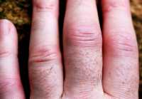 "Rheumatoid Arthritis Fingers" by david__jones is licensed under CC BY 2.0. To view a copy of this license, visit: https://creativecommons.org/licenses/by/2.0