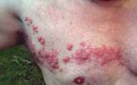 Herpes Zoster - Shingles on chest Wikipedia image