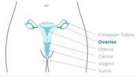 Site of Ovarian Cancer - Wikipedia Image