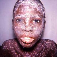 This 1967 photograph, which was captured in Accra, Ghana, depicts the face of a smallpox patient,