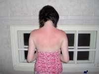 “Lianne's Sunburn!!” by Richard Riley is licensed under CC BY 2.0