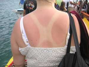 “Sunburn” by Beatrice Murch is licensed under CC BY 2.0