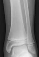 Radiogram of distal tibia (left) and fibula (right) showing two epiphyseal plates. Wikipedia Image