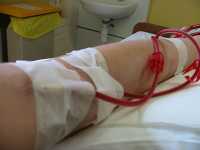dialysis, hemodialysis